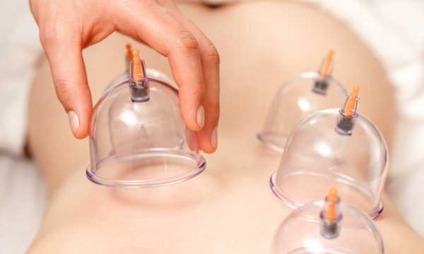 Cupping-Therapy-in-Practice-Types-of-Cups-and-Ideal-Uses-1-1.jpg
