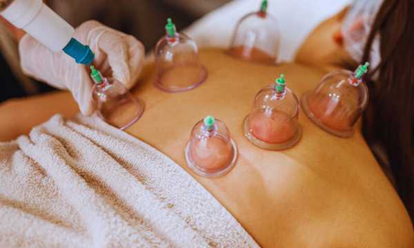 Cupping-Therapy-in-Practice-Types-of-Cups-and-Ideal-Uses-1.jpg